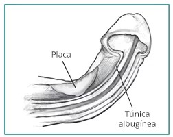 Peyronie curvatura 2